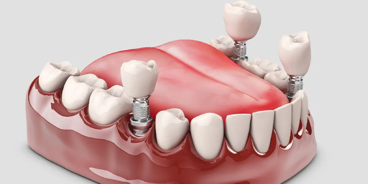 All You Need To Know About Dental Implants In Goa