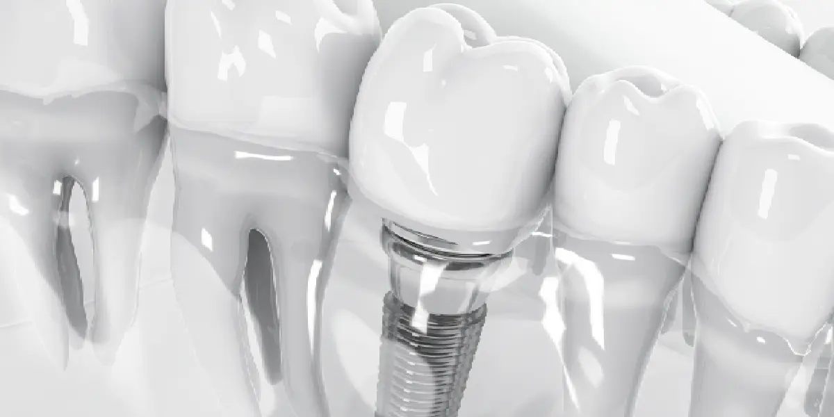 Dental Implants in Margao: Re Establish Your Smile with Confidence