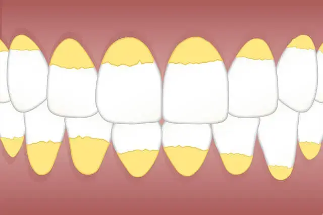 Does teeth whitening have any side effects? Find out here!
